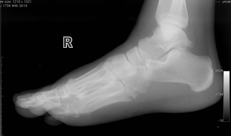 Hairline Fractures Explained A-z. Causes, Symptoms, Treatments